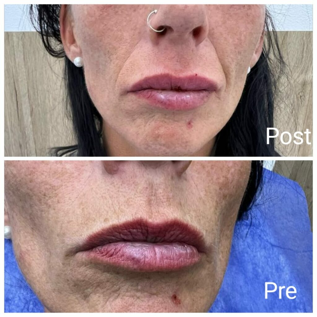 Lip augmentation with fillers